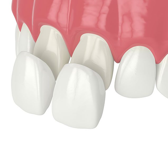 What are Porcelain Venners | Cranston Dental Centre | Calgary AB