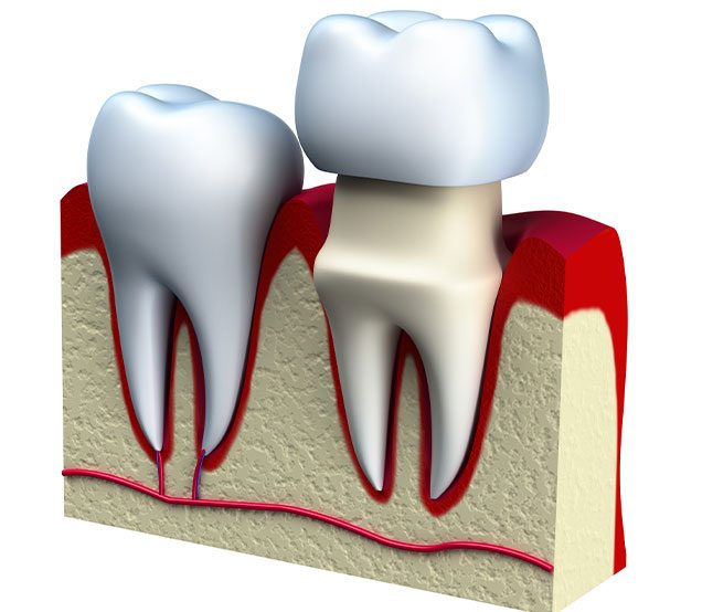 What is a dental crown | Family Dentist | Cranston Dental Centre | Calgary AB