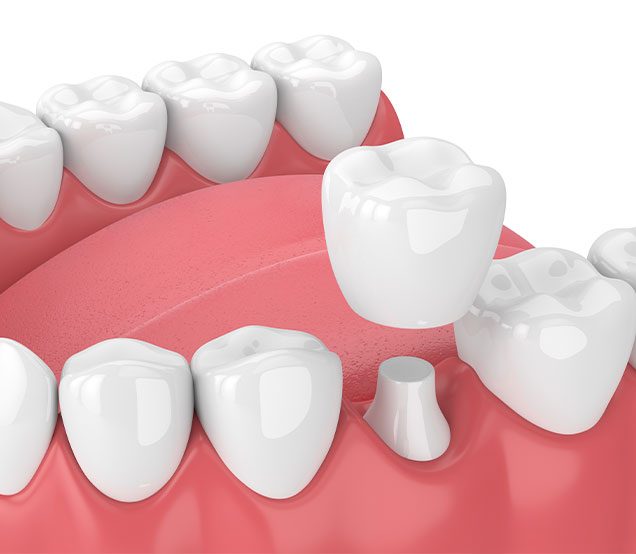 Calgary dental crown treatment | Cranston Dental Centre | General Dentistry | Calgary AB