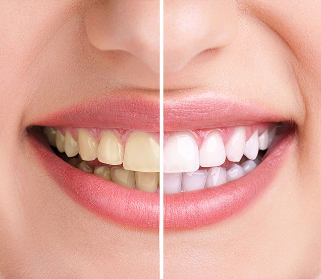 What is Teeth Whitening Services | SE Calgary family dentist | Cranston Dental Centre