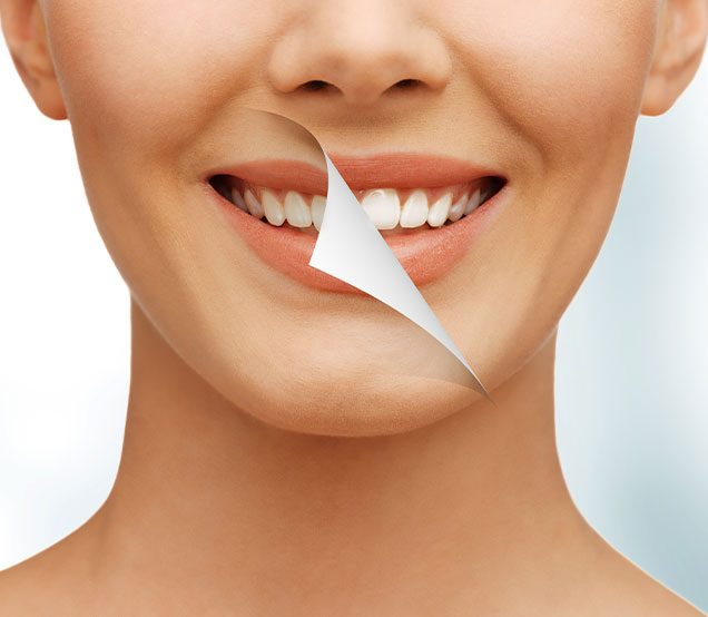 Cosmetic Teeth Whitening | SE Calgary Family Dentist | Cranston Dental Centre | Calgary AB