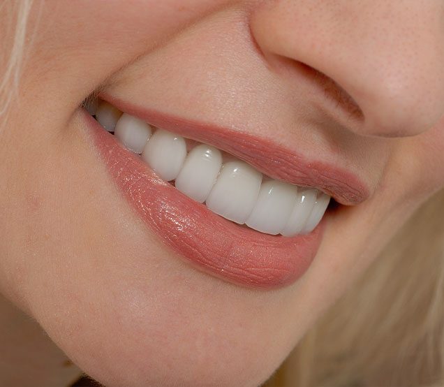 Calgary Porcelain Veneers | General Dentist | Cranston Dental Centre | Calgary AB