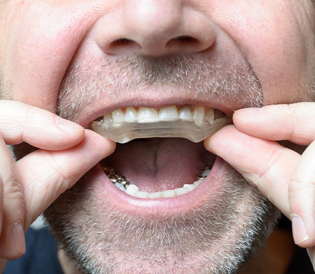 Bruxism and Clenching Splint & Bite Correction | Cranston Dental Centre | Calgary AB