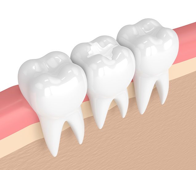 Calgary Trusted Choice For Tooth Colourd Fillings | General Dentist | Cranston Dental Centre